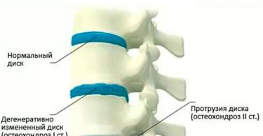 Что можно при протрузии, а от чего стоит отказаться Можно ли заниматься спортом